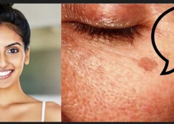 safe pigmentation treatment, pigmentation treatment without skin damage, dermatologist pigmentation treatment, melasma treatment India, laser pigmentation treatment, chemical peels for pigmentation