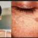 safe pigmentation treatment, pigmentation treatment without skin damage, dermatologist pigmentation treatment, melasma treatment India, laser pigmentation treatment, chemical peels for pigmentation