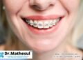 Best Orthodontist in Vishrantwadi Pune 5 Invisalign treatment Pune, Clear aligners Vishrantwadi, Dr. Mathesul dental clinic, Best dentist in Kalyani Nagar, Braces specialist East Pune, Dental implants Pune, Orthodontic clinic near me, Ceramic and metal braces Pune, Smile makeover Vishrantwadi, Expert orthodontist in Pune,Best Orthodontist in Vishrantwadi Pune