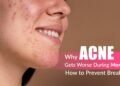 Why Acne Gets Worse During Monsoon & How to Prevent Breakouts 3 Monsoon Acne, Rainy Season Breakouts, Acne Prevention Tips, Clogged Pores Humidity, Dermapuritys, Oily Skin Monsoon Care, Acne Treatment