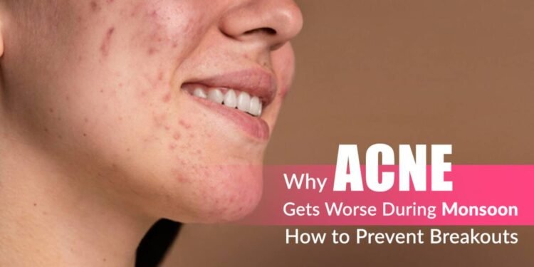 Monsoon Acne, Rainy Season Breakouts, Acne Prevention Tips, Clogged Pores Humidity, Dermapuritys, Oily Skin Monsoon Care, Acne Treatment