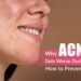 Monsoon Acne, Rainy Season Breakouts, Acne Prevention Tips, Clogged Pores Humidity, Dermapuritys, Oily Skin Monsoon Care, Acne Treatment
